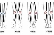 小腿后弯变直的方法（小腿向后弯了）