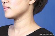 颈纹是怎么形成的怎么去除颈纹（颈纹是如何形成的颈纹的淡化方法）