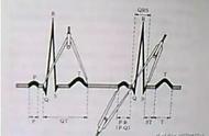 心电图全套讲解（11种异常心电图）