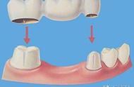 缺三颗磨牙怎么补（21岁第一磨牙缺了一颗怎么处理）