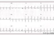 右心房肥大心电图特点及常见于何种疾病