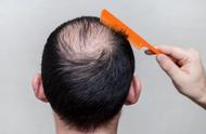 胱氨酸片对脂溢性脱发有效果吗（胱氨酸片男性吃副作用）
