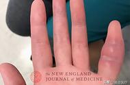 单个手指肿胀的七种原因（单个手指肚突然肿胀是怎么回事）