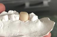 口内自凝临时牙制作技巧（制作临时牙步骤）