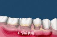 牙龈萎缩牙齿松动有办法补救吗（牙龈萎缩用什么牌子的牙膏最好）