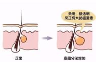 痘痘粉刺黑头（痘痘粉刺黑头全部消灭）