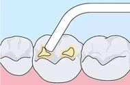牙缝之间有洞补牙过程（门牙缝隙最佳补牙方式）