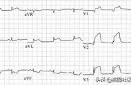 心梗病人的心电图图片（心梗的心电图表现图片）