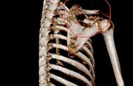 右后上背疼痛位置图详解（右背部疼痛对照表）