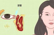 泪道堵塞自己治疗妙招（成年人泪道堵塞按摩最佳疏通方法）