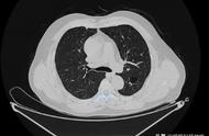 肺ct报告专业术语（肺ct值一览表）