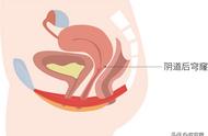 接触性出血能自愈吗（无痛性出血能自愈吗）