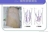 腹部评估实训结果（护理腹部评估操作视频学生）