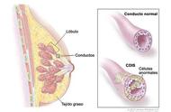 浸润性乳腺癌二级怎么治疗（浸润性乳腺癌二期怎么治疗）