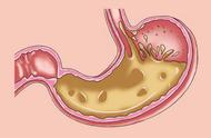 吃奥美拉唑一周还嗳气（嗳气吃了奥美拉唑没有好转）
