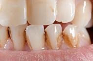 牙本质暴露的牙能用几年（牙本质暴露很多还能修复吗）