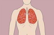 肺癌是哪边背痛（早期肺癌背疼位置图）