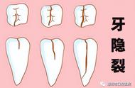 牙齿裂开如何修复最好（牙齿裂纹怎么修复最快）