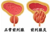 前列腺炎和前列腺癌的区别（前列腺炎和前列腺癌核磁共振区别）