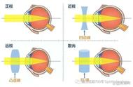 屈光不正通俗易懂解释（屈光不正什么意思啊怎么解决）