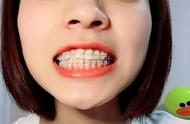 矫正牙齿的危害有哪些（牙齿矫正多少钱价格表2023）