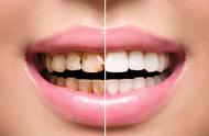 牙黄怎样变白的方法最简单（牙黄变白最快最有效的方法）