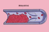 跌倒后引起的下肢浮肿（摔倒后过段时间下肢水肿）