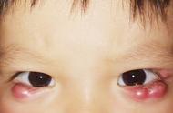 小孩眼角内长了个小白脓点（小孩眼角里有白色的小脓包）