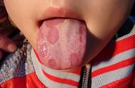 儿童常见舌头图解（儿童正常舌头图片对照表）