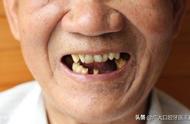 老年人拔牙后多久装假牙（75岁老人适合什么假牙）