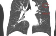 肺有纤维钙化灶严重吗（纤维灶可怕吗）