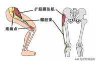 膝盖外侧疼（膝盖各个部位疼痛图解）