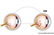 眼底出血的六个阶段（眼底出血恢复的几个时期）