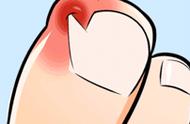 指甲盖疼怎么回事（指甲和肉连接处疼是什么原因）