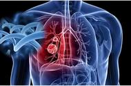 肺部磨玻璃结节大概几年会恶变（肺部磨玻璃结节长期存在危险吗）