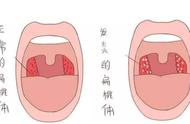 扁桃体发炎多喝水自愈（扁桃体发炎一招解决）