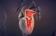 如何判断心脏是否建立侧支循环（如何知道心脏侧支循环的好处）