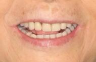 人有多少颗牙齿才算正常（32牙与28牙哪个好）