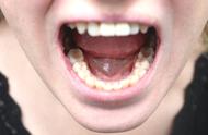54岁牙齿松动是什么原因（40岁左右牙齿松动是怎么回事）