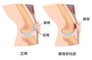 膝盖不肿不红但是弯曲用力疼（膝盖摔伤一个月了弯曲有紧绷感）