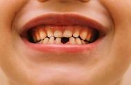 八岁孩子换牙长得很慢怎么回事（8岁儿童换牙长半截不长了）
