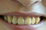 牙齿黄要用什么刷才能刷白（牙黄变白最实用的方法）