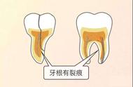 牙齿裂开图片（大牙从中间裂缝成两半）