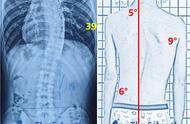 胸椎侧弯10度图片（脊柱侧弯矫正六个动作）