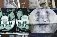 腰间盘突出微创恢复过程（腰间盘突出微创手术正确锻炼方法）