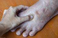 老年人脚肿是死亡前兆吗（心衰晚期的最后一个征兆）